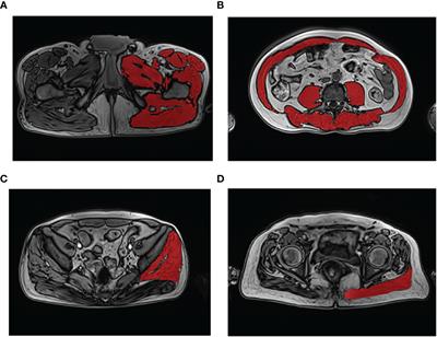 High prevalence of sarcopenia and myosteatosis in patients undergoing hemodialysis